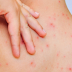How To Cope With Acne On The Back