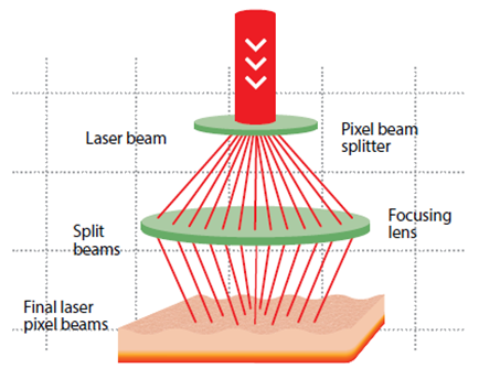 Laser Vaginal Rejuvenation