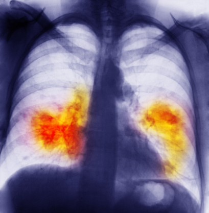 Mesothelioma Cancer Symptoms: Stages And Diagnosis Of Mesothelioma