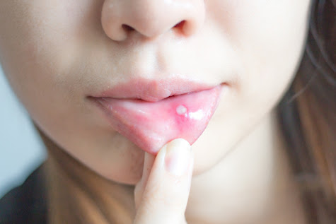 Oral Thrush Symptoms And Early Stages