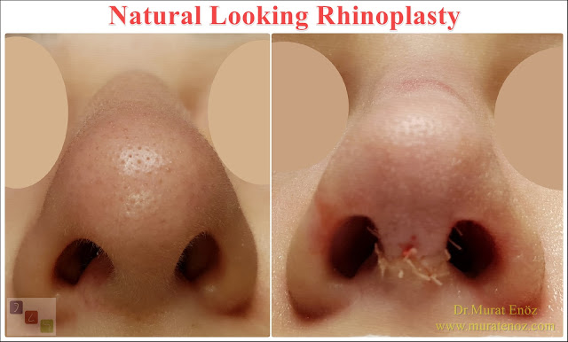 Natural Looking Rhinoplasty - Natural Nose Job - Natural Rhinoplasty - Female Nose Aesthetic Surgery - Nose Jobs For Women - Nose Reshaping for Women - Best Rhinoplasty For Women Istanbul - Female Rhinoplasty Istanbul - Nose Job Surgery for Women - Women's Rhinoplasty - Nose Aesthetic Surgery For Women - Female Rhinoplasty Surgery in Istanbul - Female Rhinoplasty Surgery in Turkey