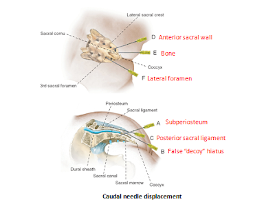 Needle Misplacement during Caudal block