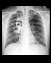 How to read chest X ray