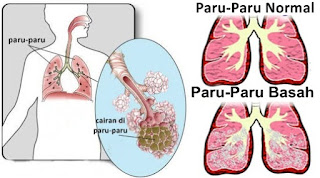 paru paru basah