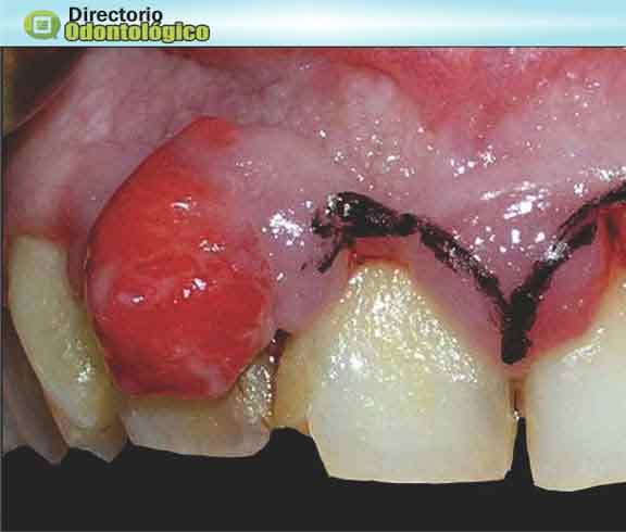 Aumento Gengival