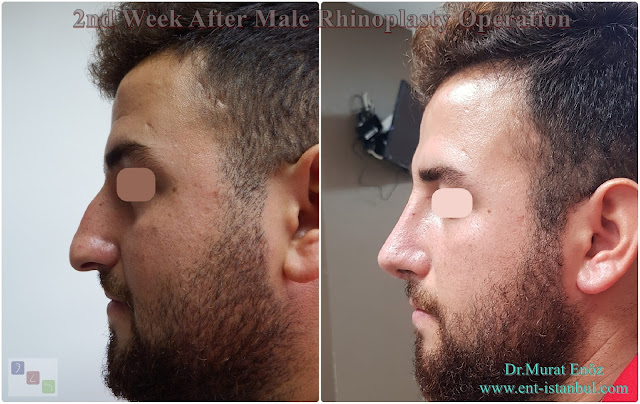 2nd Week After Male Rhinoplasty Operation