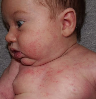 Baby Heat Rash