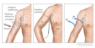   cancer de la lymphe, cancer de la lymphe chance de survie, cancer ganglions lymphatiques chance de survie, cancer lymphatique guerison, cancer de la lymphe stade 4, cancer des ganglions chance de survie, lymphome prise de sang, lymphome stade 4, systeme lymphatique des jambes