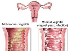 Keputihan Pada Wanita