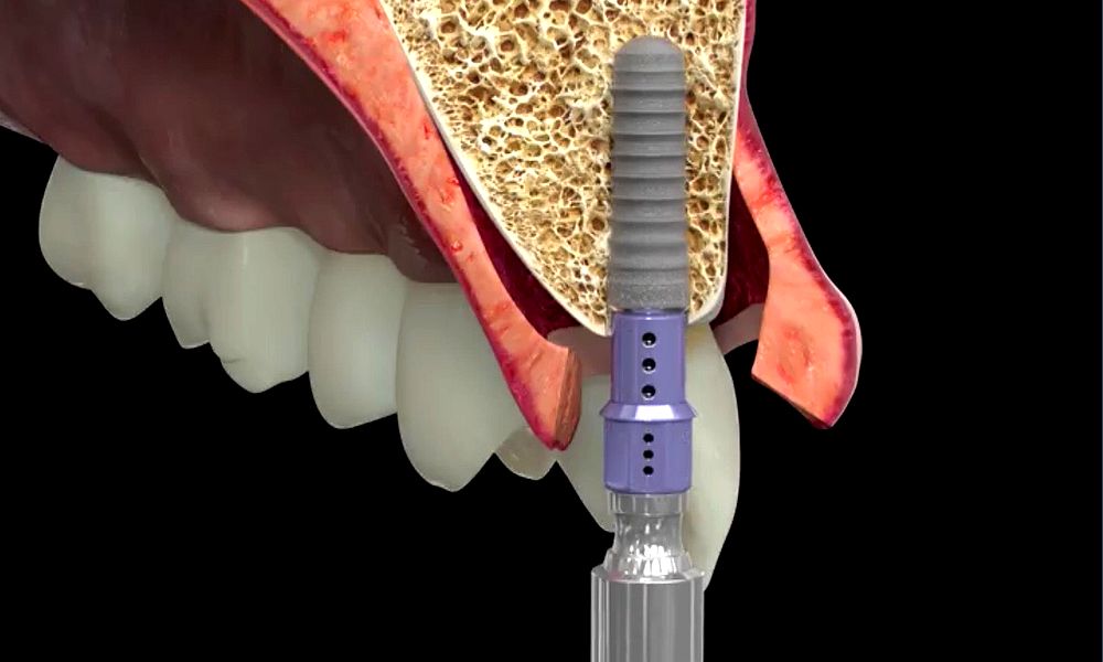 Implantes Dentales