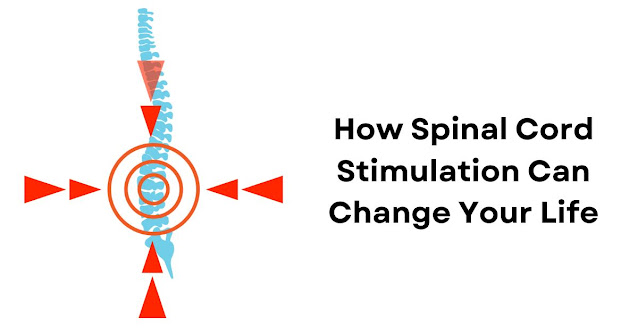 Spinal Cord Stimulation - Healthegy