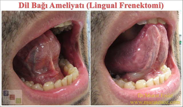 Dil bağı kesilmesi öncesi lokal anestezik enjeksiyonu - Dil bağı ameliyatı öncesi lokal anestezik ilaç - Dil bağı operasyonu - Dil altı bağı kesilmesi - Dil bağı tedavisi - Lingual frenektomi - Dil bağı dokusu çıkarılması - Dil altı bağı operasyonu