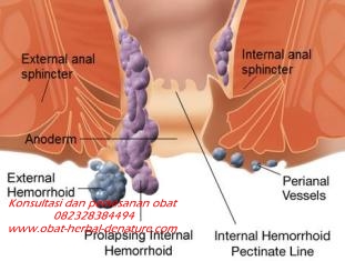 Cara Mengobati Benjolan Ambeien Stadium 3 Tanpa Operasi,Cara Menghilangkan Benjolan Ambeien Wasir Stadium 3 Tanpa Operasi,Cara Mengobati Ambeien Stadium 3 Dengan Obat Herbal,Pengobatan Ambeien Stadium 3 Tanpa Operasi,Obat Untuk Mengobati Ambeien Stadium 3 Secara Alami,Obat Herbal Untuk Ambeien Stadium 3 Yang Aman Untuk Ibu Hamil,Obat Ambeien Wasir Stadium 3 Tanpa Operasi,Obat Herbal Denature Untuk Ambeien Stadium 3,Obat Untuk Menghilangkan Benjolan Ambeien Stadium 3 Tanpa Operasi,Menghilangkan Benjolan Ambeien Stadium 3 Tanpa Operasi,