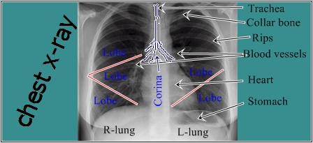  Chest X-ray seen photo