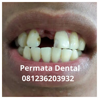 gambar foto gigi ompong caries berlubang keropos rusak