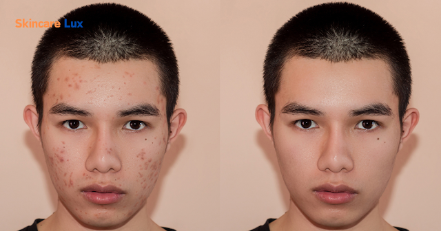  Face Pimples: A Guide to Understanding and Treating Them