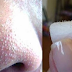 Como remover cravos do nariz usando água, sal e limão - APRENDA.