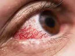 Black Fungs Disease In Hindi | Black Fungs Ki Janakari