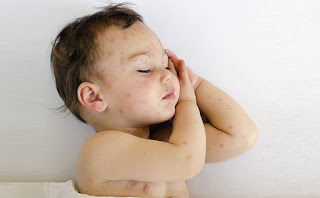 Home Remedies For Bed bug Bites on Babies and Toddlers