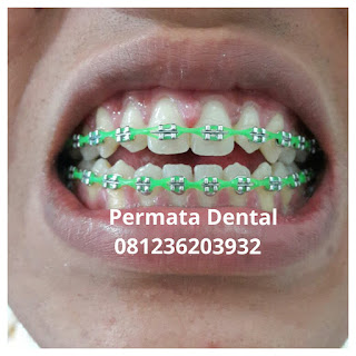 gambar foto behel bracket kawat gigi sebelum dan sesudah perawatan untuk memperbaiki merapikan gigi gingsul gigi miring renggang tonggos berantakan keluar masuk jarang diastema maju mundur tidak rapi tidak beraturan bali denpasar banyuwangi jember tidak rata kocar kacir