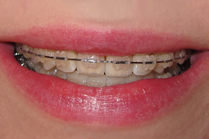 Malocclusion Class Ii. 2 Months, 16 Days