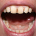6 Cara menghilangkan noda hitam pada gigi secara alami dan cepat