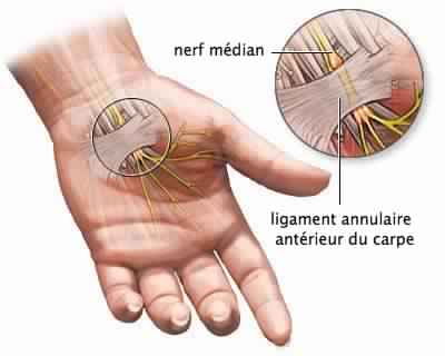 Comment traiter le syndrome du canal carpien