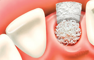 Khi nào cần ghép xương trong cấy ghép Implant ?