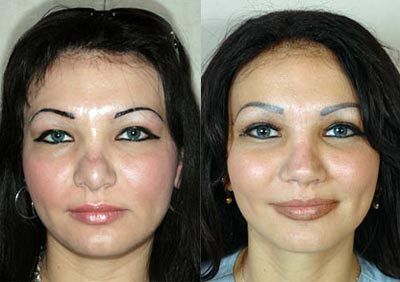 Rhinoplasty Pics