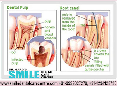 Painless Root Canal Treatment in Faridabad