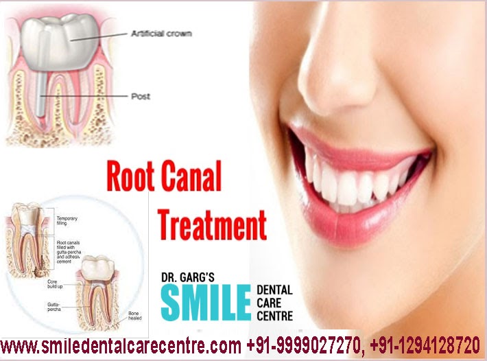 Procedures and Benefits Of Painless Root Canal Treatment