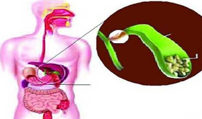 পিত্তথলিতে পাথর হলে