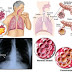 Penyakit Paru-Paru Dan Cara Mengobati