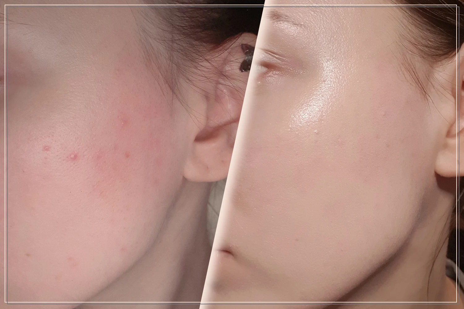 concealing breakouts on the face before and after picture
