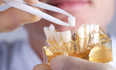 Trường hợp nên cấy ghép răng implant