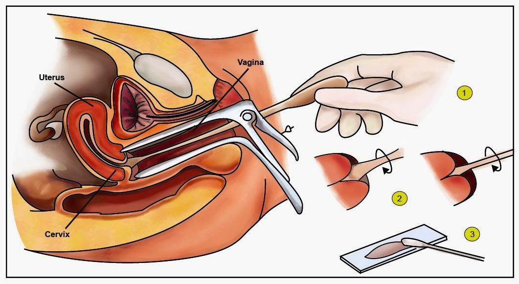 pengobatan herbal kanker serviks, obat kanker serviks alami stadium 1, obat kanker serviks stadium 4