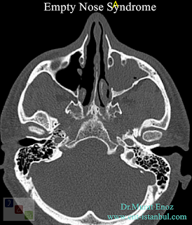 cold turbinate,ENS,Nasal physiology,Empty Nose Syndrome,healthy turbinates,Nasal Hyperventilation,
