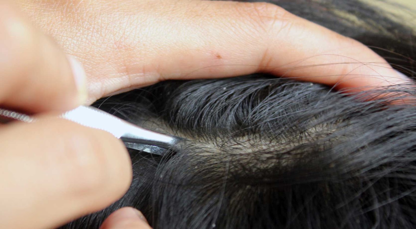 Cara Mudah Menghilangkan Kutu Rambut Dan Telurnya Ampuh Secara Alami