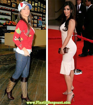 nicki minaj plastic surgery before and. nicki minaj bum implants