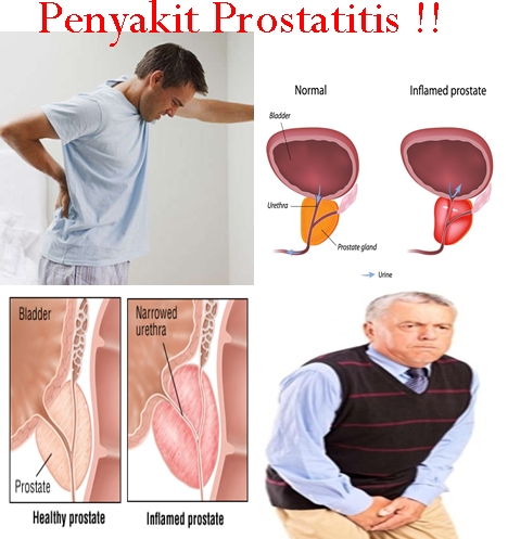 Obat Tradisional Prostatitis