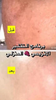 برنامج تفتيح منزلي فعال للوجه والمناطق الحساسة الداكنة 3 خطوات مره وحده فقط 👌 I&C