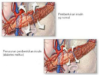 Cara Mengobati Diabetes Melitus