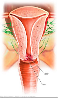 Pictures Of Cervical Cancer