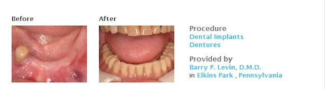 View Dental Implants Before and After Photos  