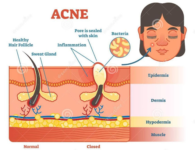 acne in adults