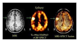 SPECT Epilepsy