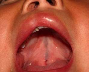 Submucous Cleft Palate Images, Symptoms, Causes, Treatment