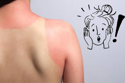 What is The Fastest Home Remedy for Sunburn