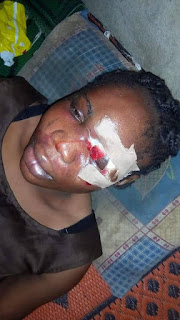 Breaking: Nigerian lady left with a serious battered eye by her boyfriend who she is set to wed in August (photos)