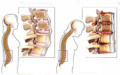 Kiểm soát cơn đau do thoái hóa cột sống